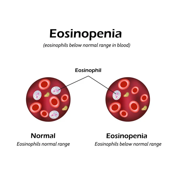 Eosinófilos por debajo del rango normal en la sangre. Eosinopenia. Infografías. Ilustración vectorial — Vector de stock