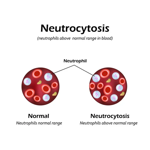 Neutrofily byly nad normální rozmezí v krvi. Neutrocytosis. Vektorové ilustrace — Stockový vektor