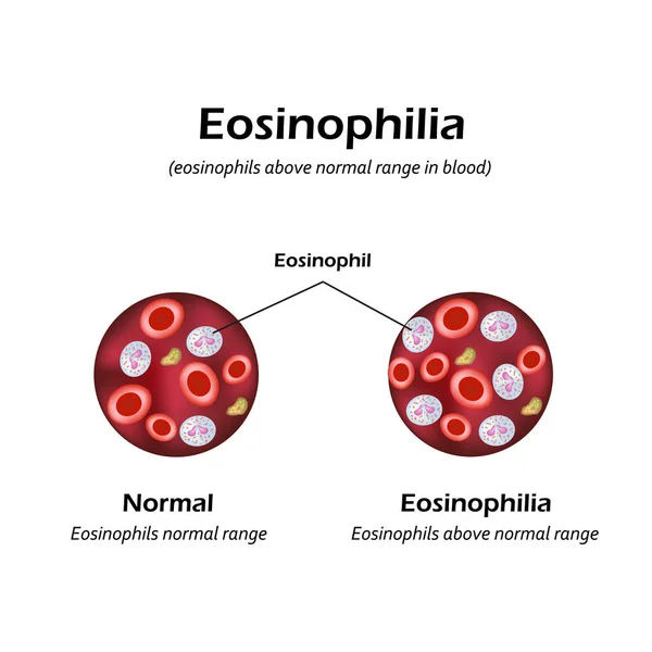 Eozinofilů nad normální rozmezí v krvi. Eozinofilie. Infografika. Vektorové ilustrace — Stockový vektor