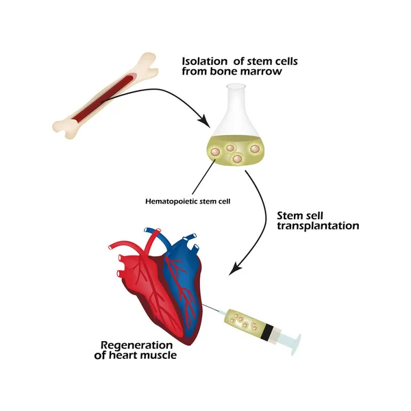 Células-tronco da medula óssea são usadas para regenerar o músculo cardíaco. Infográficos. Ilustração vetorial — Vetor de Stock