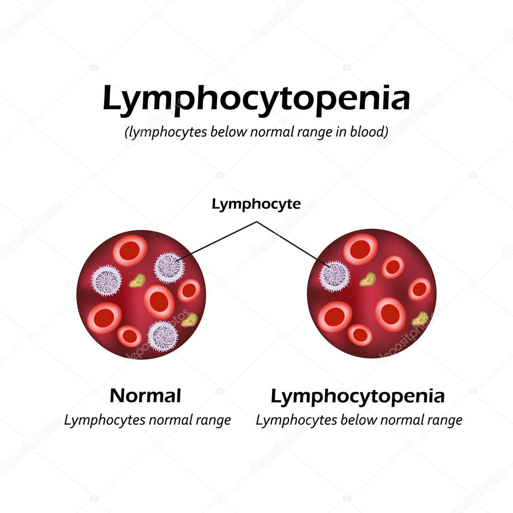 Lymphocytes below the normal range in the blood. Lymphocytopenia. Vector illustration