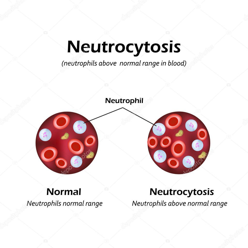 Neutrophils were above the normal range in the blood. Neutrocytosis. Vector illustration