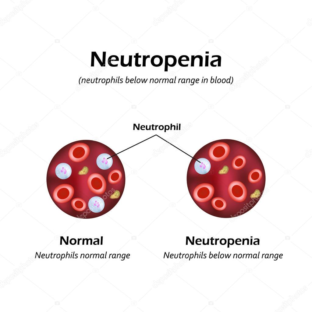 Neutrophils below the normal range in the blood. Neutropenia. Vector illustration