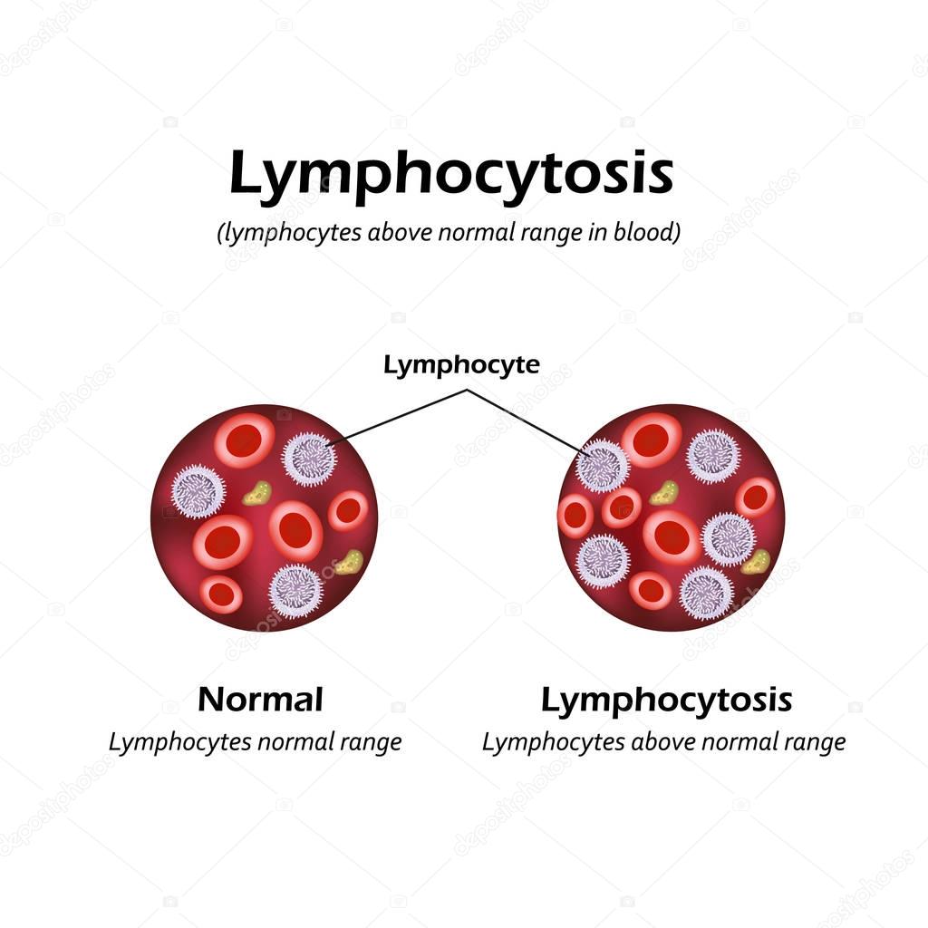 Lymphocytes above the normal range in the blood. Lymphocytosis. Vector illustration