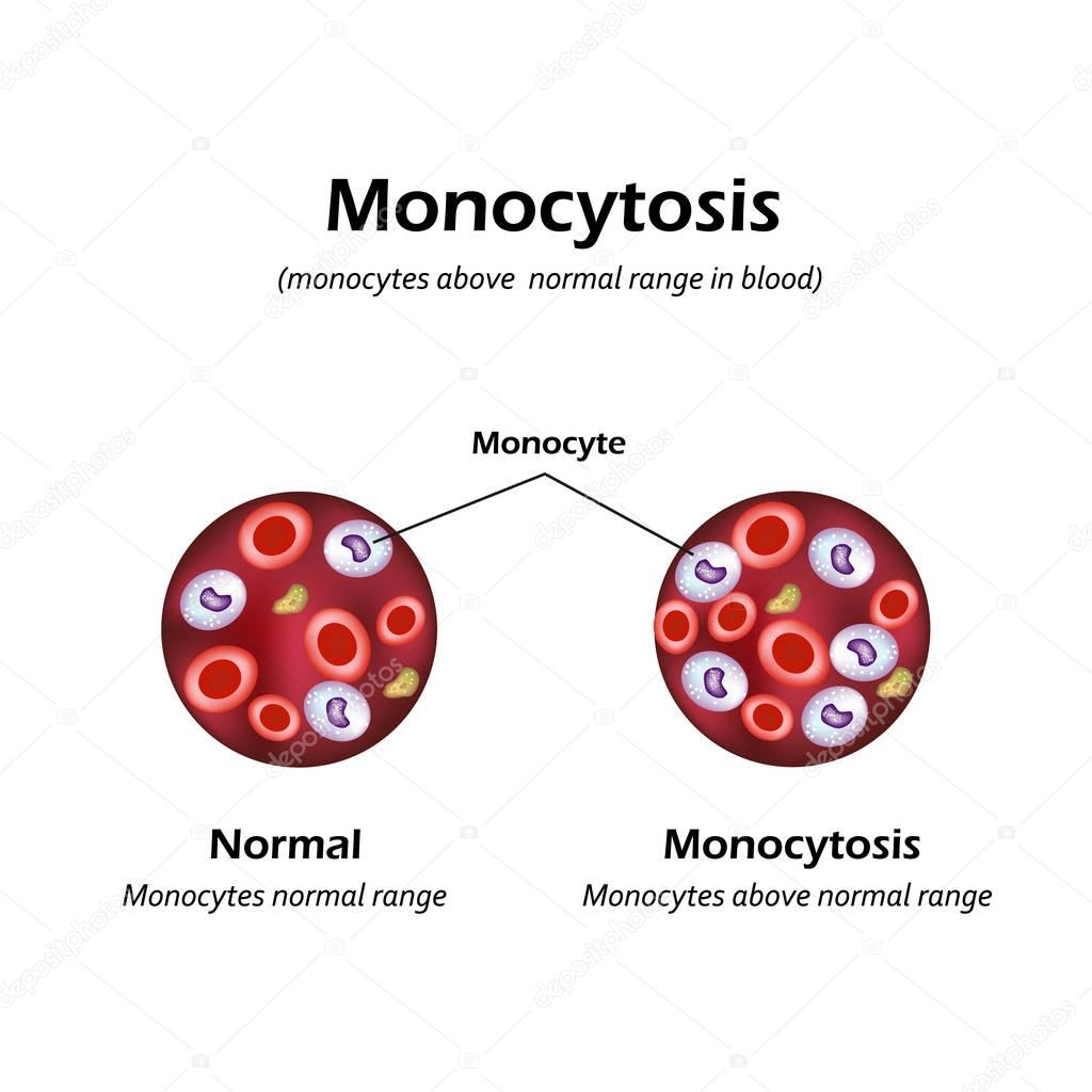Monocytes above the normal range in the blood. Monocytosis. Vector illustration