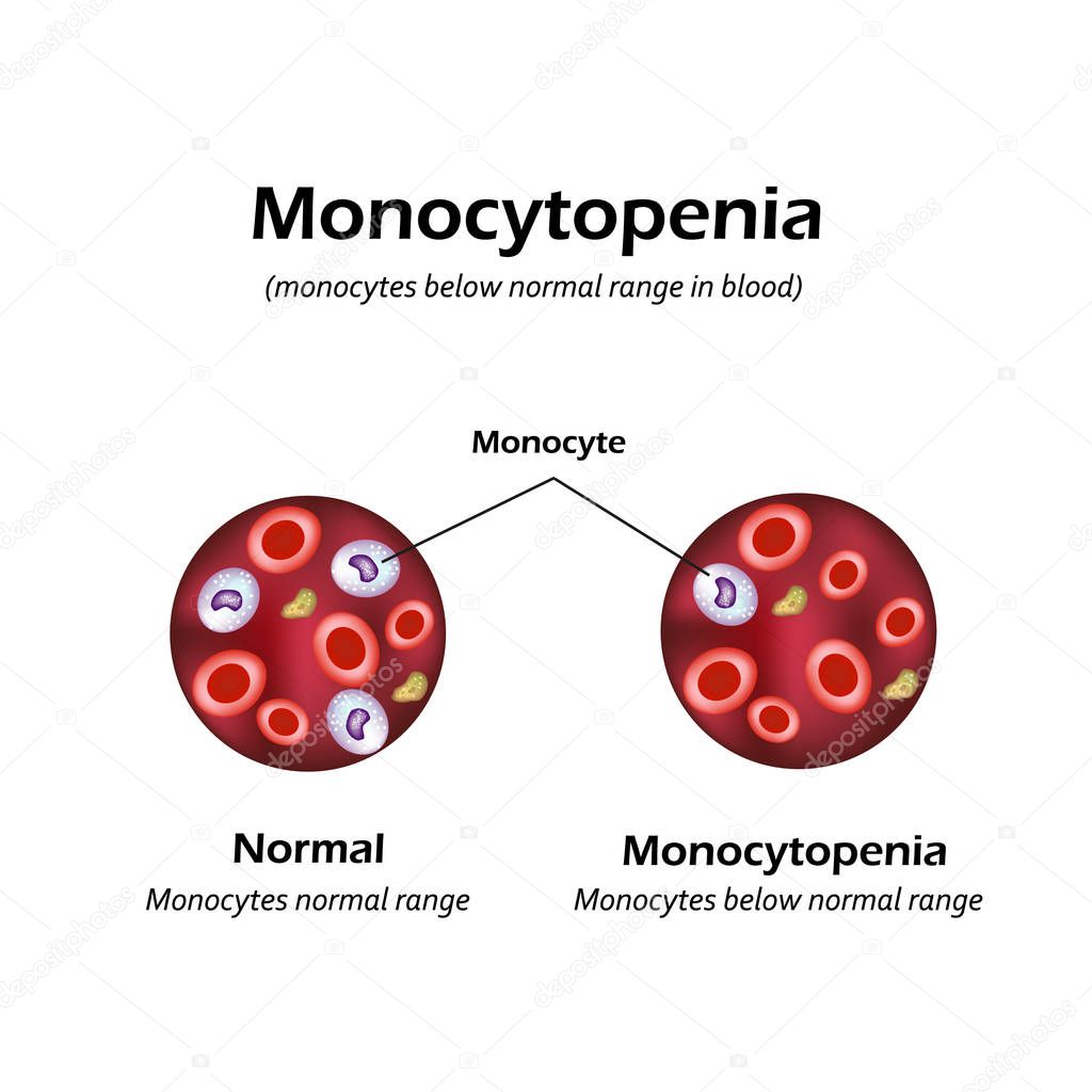 Monocytes below the normal range in the blood. Monocytopenia. Vector illustration