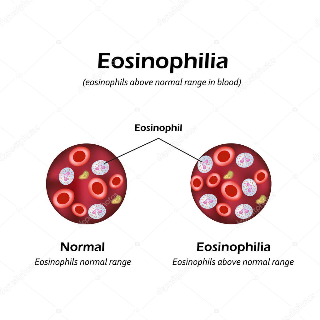 Eosinophils above normal range in blood. Eosinophilia. Infographics. Vector illustration