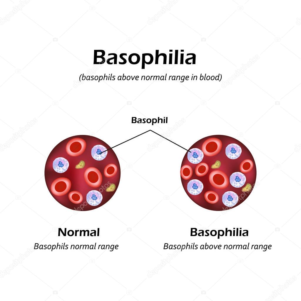 Basophils above the normal range in the blood. Basophilia. Infographics. Vector illustration