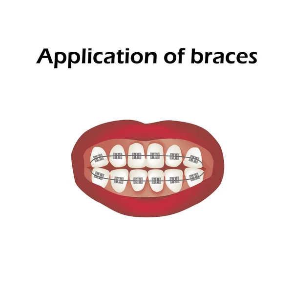 The use of braces. Crooked teeth. Orthodontics. Infographics. Vector illustration on isolated background — Stock Vector