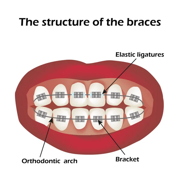 The structure of the braces. Orthodontics. Infographics. Vector illustration on isolated background — Stock Vector