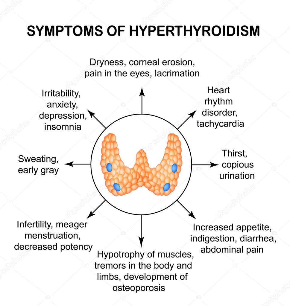 Symptoms of hyperthyroidism. Thyroid. Infographics. Vector illustration on isolated background.