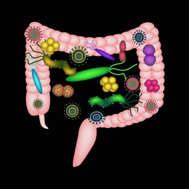Dysbacteriosis of the intestine. The large intestine. dysbiosis of colon. Bacteria, fungi, viruses. Infographics. Vector illustration on black background. clipart
