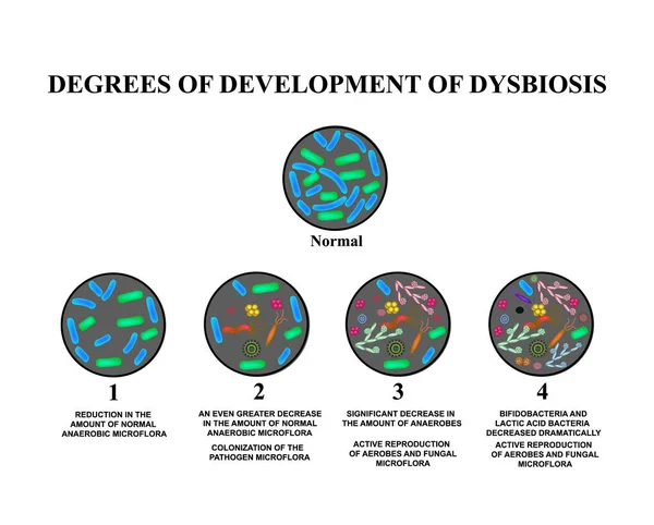 4 fejlettségi diszbiózis. A bél dysbacteriosis. A vastagbél. vastagbél diszbiózis. Baktériumok, gombák, vírusok. Infographics. Elszigetelt háttér vektor illusztráció. — Stock Vector