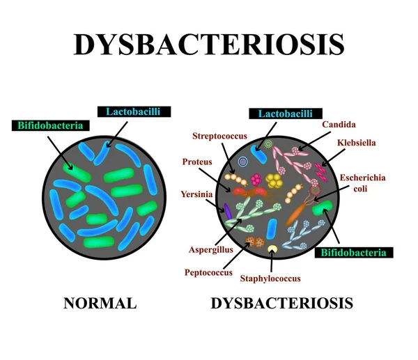 Dysbakteriose des Darms. Lactobacillus, Bifidobakterien, Streptokokken, Staphylokokken, z. B. Coli, Aspergyllus-Pilze, Candida. Infografiken. Vektor-Illustration auf isoliertem Hintergrund. — Stockvektor