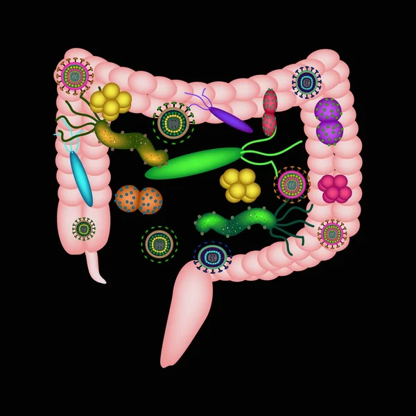 Disbacteriosis del intestino. El intestino grueso. disbiosis de colon. Bacterias, hongos, virus. Infografías. Ilustración vectorial sobre fondo negro . — Vector de stock