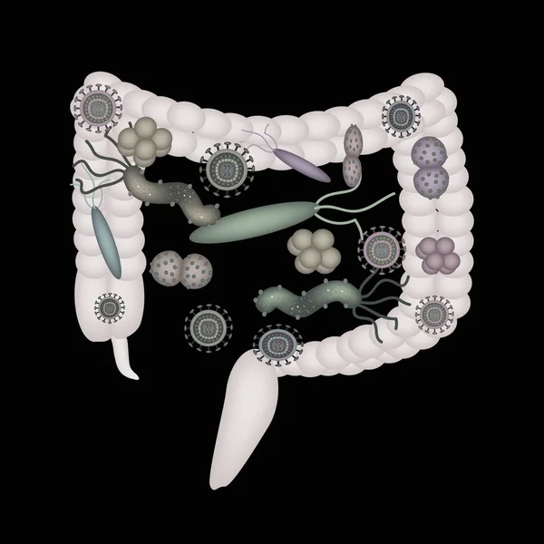 腸の腸。大腸。コロンの dysbiosis。細菌、真菌、ウイルス。インフォ グラフィック。黒の背景のベクトル図. — ストックベクタ