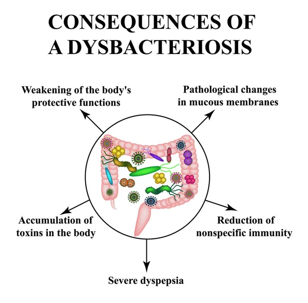 Konsekuensi dari disbiosis usus. Dysbacteriosis dari Infografis usus besar. Ilustrasi vektor pada latar belakang terisolasi . - Stok Vektor