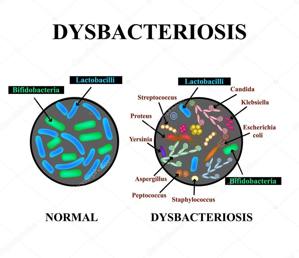 Dysbacteriosis of the intestine. Lactobacillus, Bifidobacteria, Streptococcus, Staphylococcus, E. coli, Aspergyllus mushrooms, Candida. Infographics. Vector illustration on isolated background.