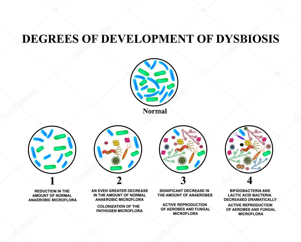 4 degrees of development of dysbiosis. Dysbacteriosis of the intestine. The large intestine. dysbiosis of colon. Bacteria, fungi, viruses. Infographics. Vector illustration on isolated background.