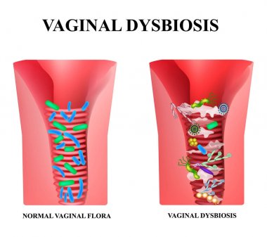 Vaginal dysbiosis. Dysbacteriosis of the vagina. Vaginitis Candidiasis. Lactobacillus, bifidobacteria. Bacteria pathogenic flora. Infographics. Vector illustration on isolated background clipart