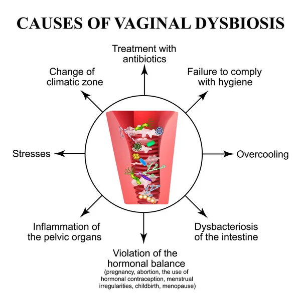Cause di disbiosi vaginale. Vaginite. Candidosi. Infografica. Illustrazione vettoriale su sfondo isolato . — Vettoriale Stock