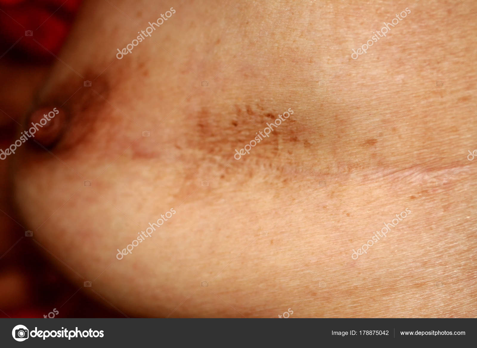 Cicatrice sur le sein après l'opération. Tache brune — Photo de ...
