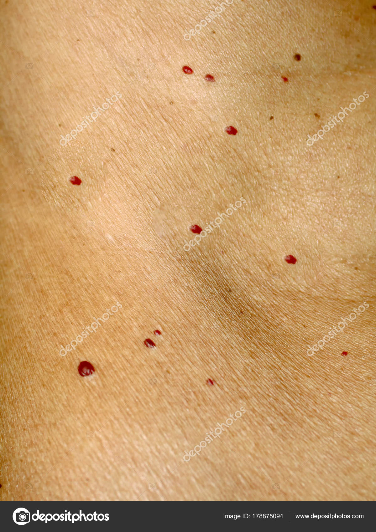 röda leverfläckar cancer