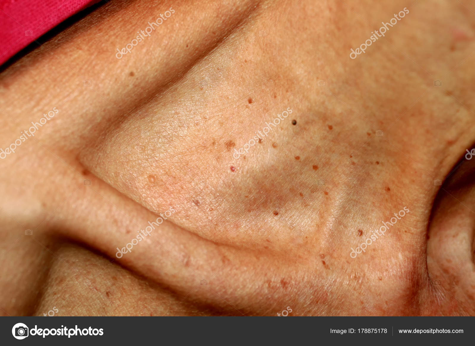 papillomatosis bőr