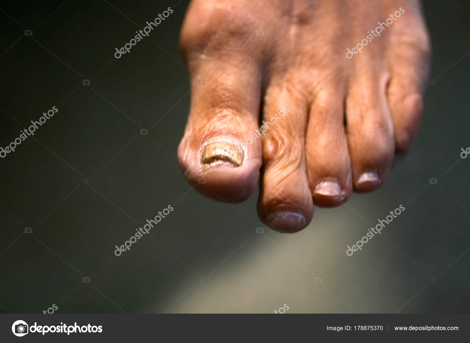 Fungus On The Nail Twisted Fingers On The Foot With Calluses Bone On The Big Toe Stock Photo Image By C Mikrostoker Fungus On The Nail Twisted Fingers On The Foot With Calluses Bone On The Big Toe Stock Photo Image By C Mikrostoker