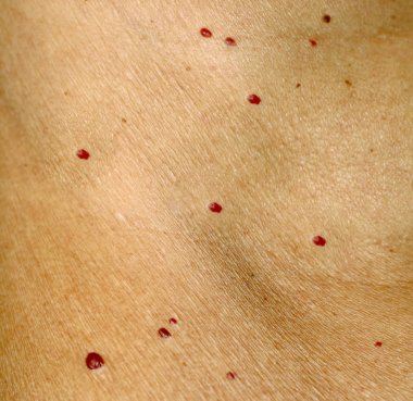 Angioma cilt üzerinde. Vücut üzerinde kırmızı benler. Pek çok doğum lekeleri.