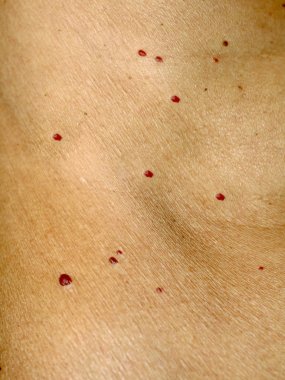 Angioma cilt üzerinde. Vücut üzerinde kırmızı benler. Pek çok doğum lekeleri.