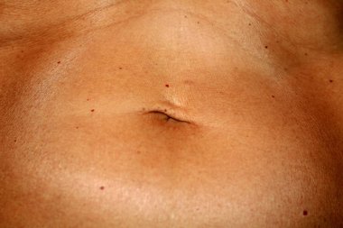 Karın içinde kırmızı anjiyoya var. Sarkık buruşuk karın. Göbek gerilir.