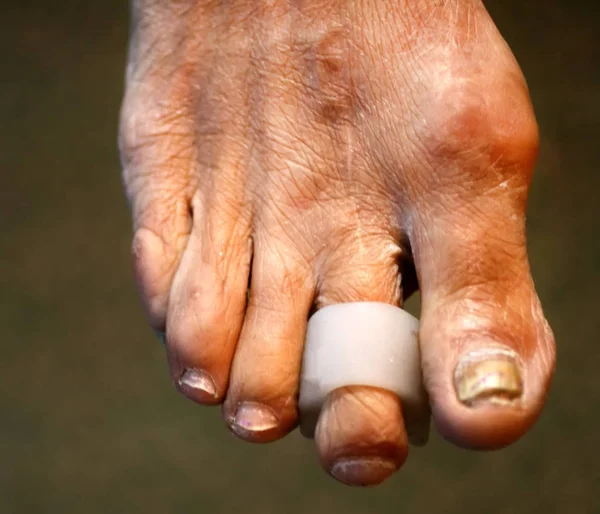 指垫分区.脚.脚趾上有玉米手指的曲率。指玉米垫. — 图库照片