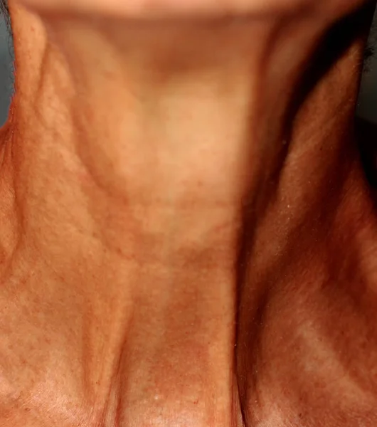 Wrinkles on the neck. Flabby skin on the neck. — Stock Photo, Image