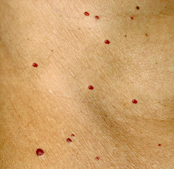 Angioma cilt üzerinde. Vücut üzerinde kırmızı benler. Pek çok doğum lekeleri.