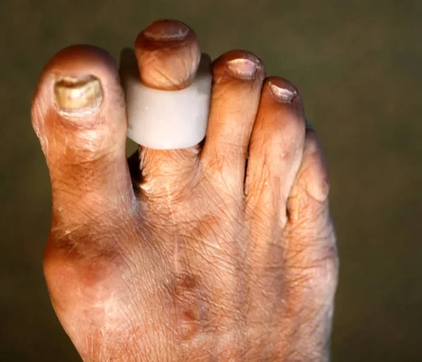 指垫分区.脚.脚趾上有玉米手指的曲率。指玉米垫. — 图库照片