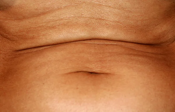 Flabby wrinkled abdomen. The navel is stretched. — Stock Photo, Image