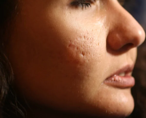 Inflamed skin of the face in pimples and acne. Keloid scars from acne — Stock Photo, Image