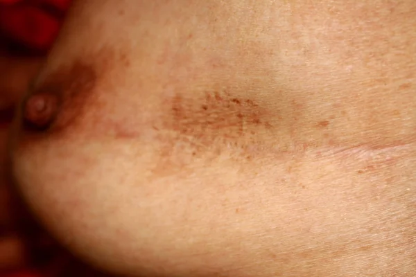 Cicatrice sul seno dopo l'intervento. Macchia marrone — Foto Stock