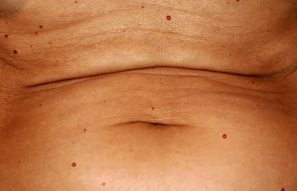 The abdomen is in red angiomas. Flabby wrinkled abdomen. The navel is stretched.