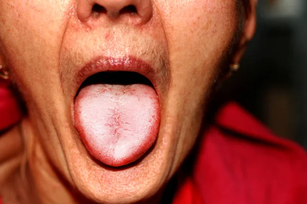 La lengua está en una redada blanca. Candidiasis en la lengua — Foto de Stock