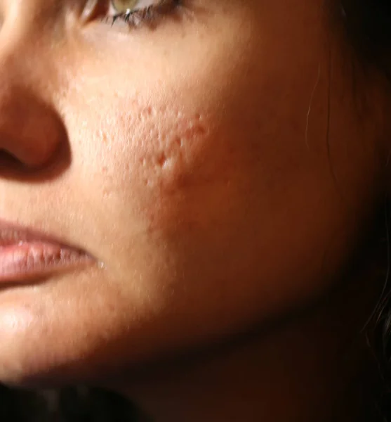 Pelle infiammata del viso nei brufoli e nell'acne. Cicatrici cheloidi da acne — Foto Stock