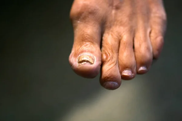 Fungo na unha. Dedos torcidos no pé com calos. Osso no dedo grande do pé . — Fotografia de Stock