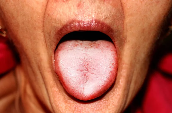 A língua está num ataque branco. Candidíase na língua — Fotografia de Stock