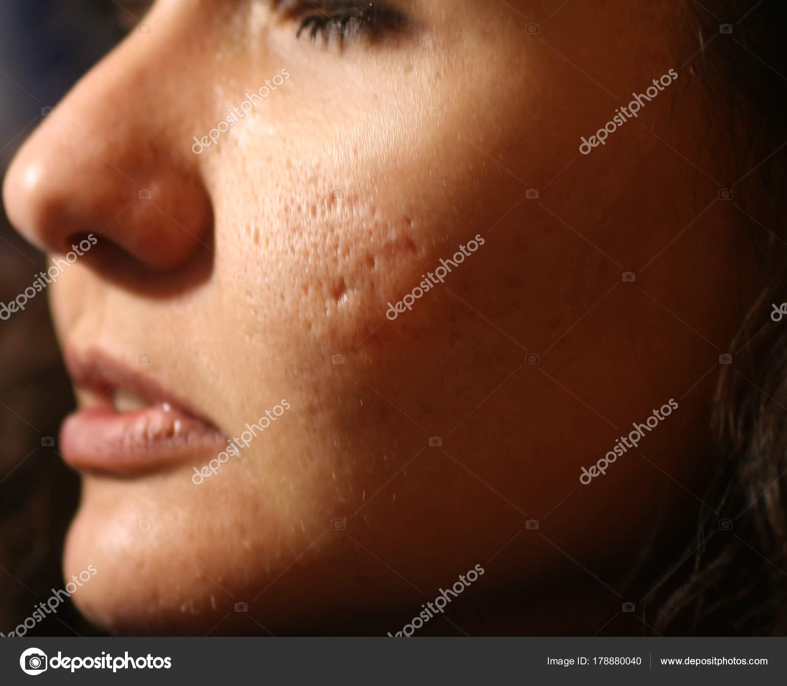 acne problem ansiktet acne problem ansiktet