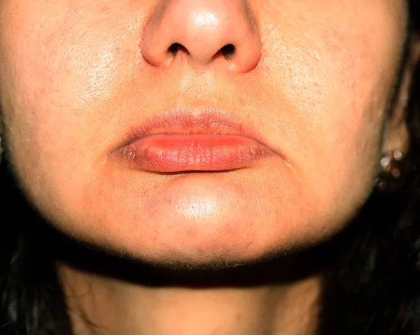 Labios con las esquinas bajas. Arrugas en los labios. Pliegues nasolabiales — Foto de Stock