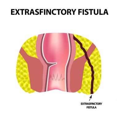 Rektum fistüller türleri. Paraproctitis. Anüs. Rektum apse. Infographics. Vektör illüstrasyon izole arka plan üzerinde