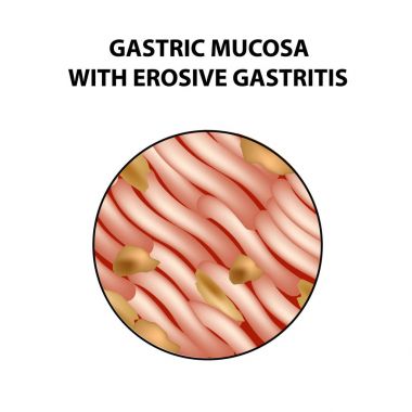 Mukus mide aşındırıcı gastrit ile. Infographics. Vektör illüstrasyon izole arka plan üzerinde
