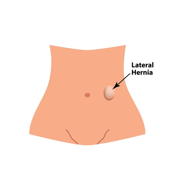 Boční herniace. střevní kýly. Infografika. Vektorové ilustrace v izolovaných pozadí. — Stockový vektor