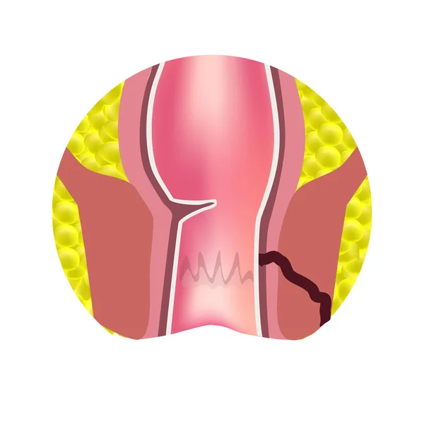 Types de fistules du rectum. Paraproctite. Anus. Abcès du rectum. Infographie. Illustration vectorielle sur fond isolé — Image vectorielle